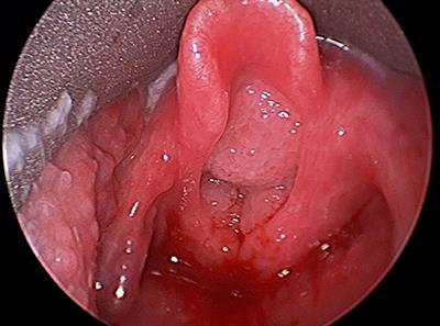 Airway Papillomatosis: New Treatments for an Old Challenge